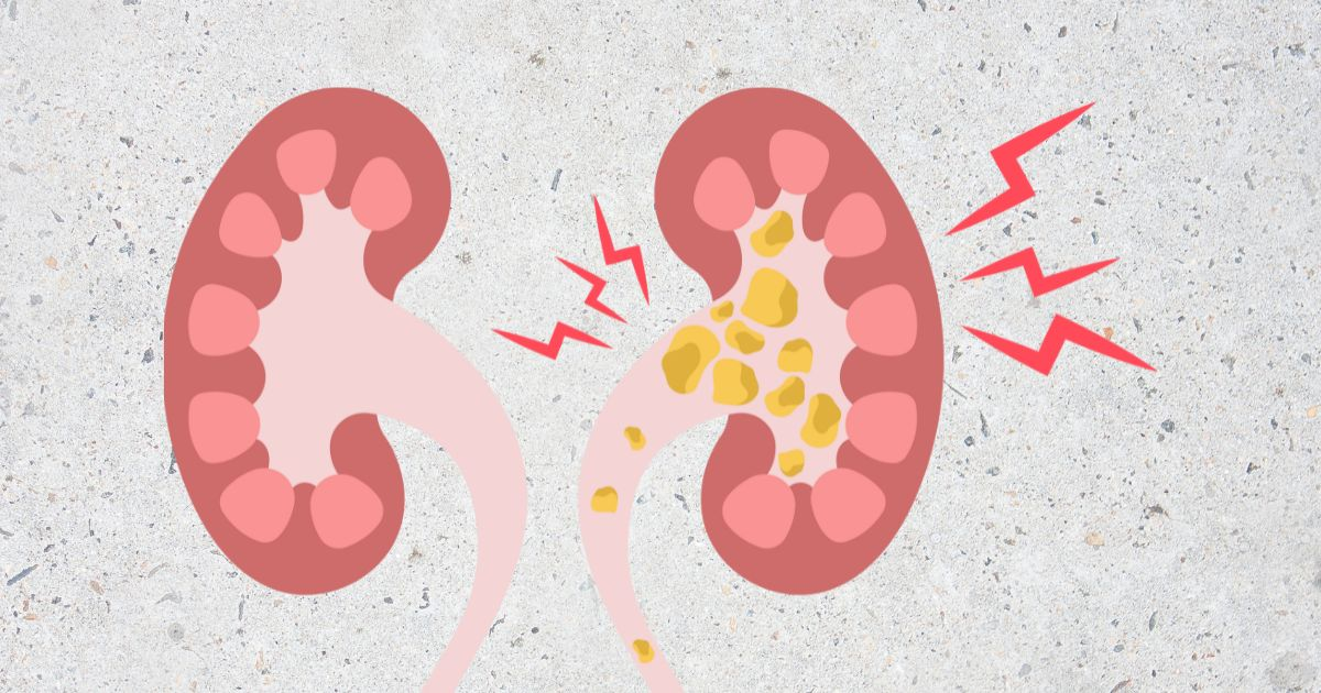 Kidneys Failing? Here’s How to Wean Them Back to Health.